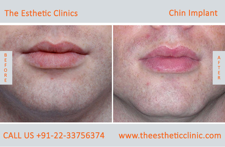 chin Augmentation, chin Implants surgery before after photos in mumbai india (6)